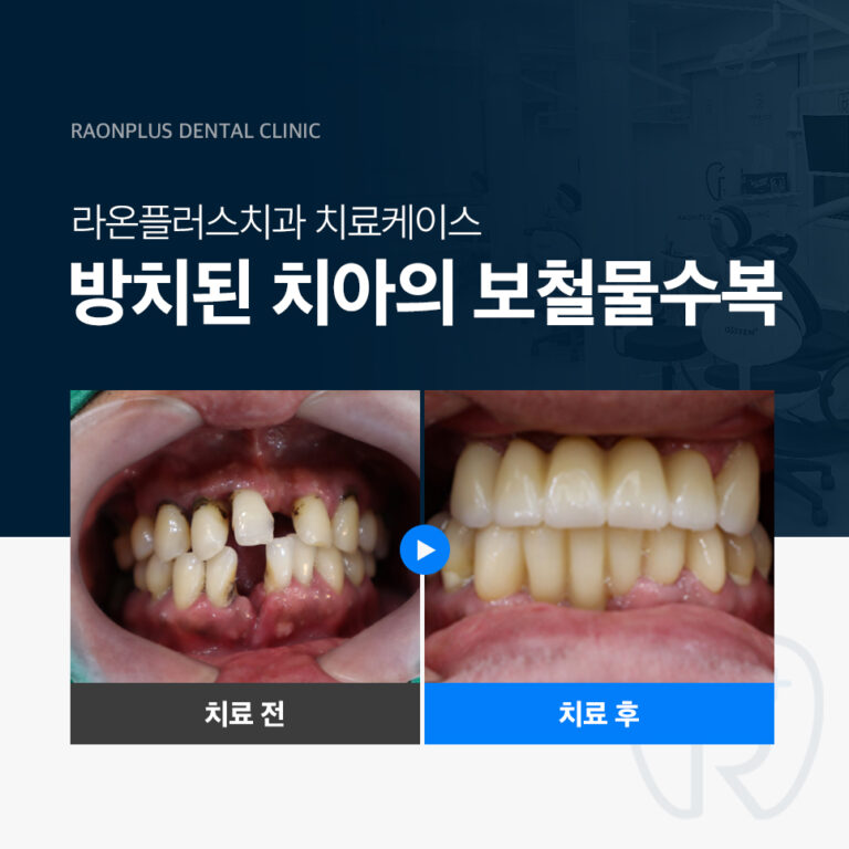 라온플러스치과 – 방치된 치아의 보철물수복 진료 케이스