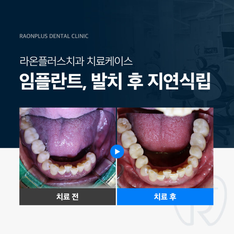 라온플러스치과 – 임플란트, 발치 후 지연식립 진료 케이스