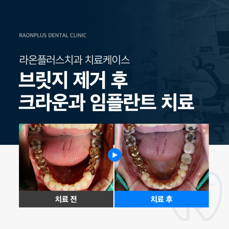 의정부치과 – 브릿지 제거 후 크라운과 임플란트 치료 진료 케이스