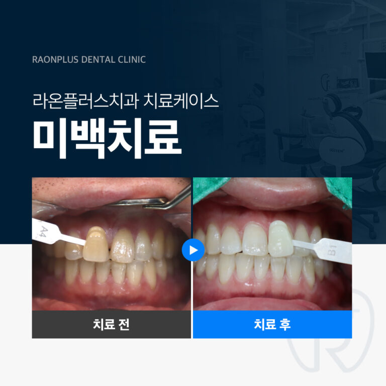 라온플러스치과 – 미백치료 진료 케이스