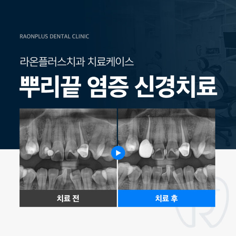 의정부치과 – 뿌리끝 염증 신경치료 진료 케이스
