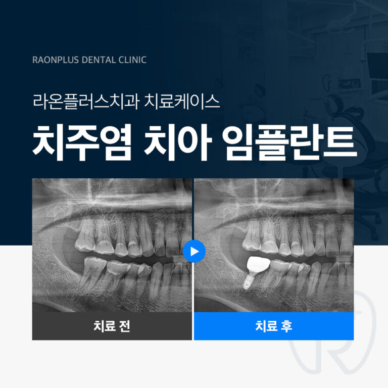 의정부치과 – 치주염 치아 임플란트 진료 케이스
